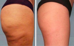 thermal slimming and anti-cellulite mask